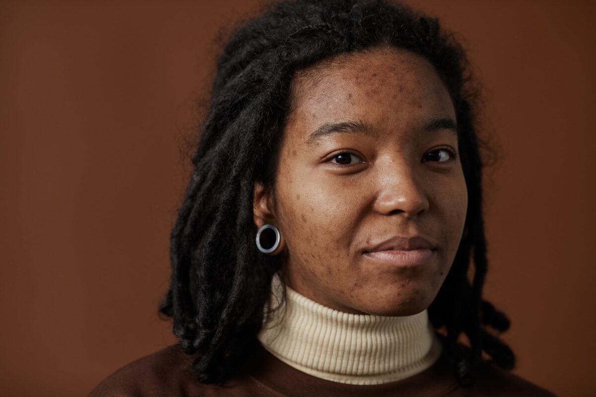 Acne da mulher adulta: motivos e tratamento! 